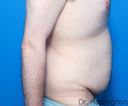 Tummy Tuck Patient Photo - Case 95 - before view-1