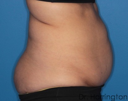 CoolSculpting® - Case 98 - Before