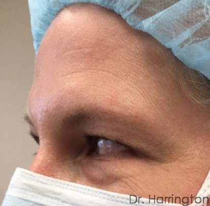 Eyelid Surgery Patient Photo - Case 100 - before view-2