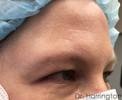 Eyelid Surgery Patient Photo - Case 100 - before view-1