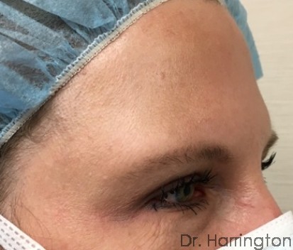 Eyelid Surgery Patient Photo - Case 100 - after view-1