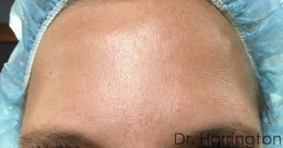 Botox - Case 101 - After