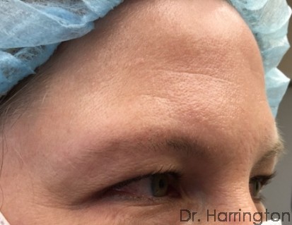 Botox Patient Photo - Case 101 - before view-1