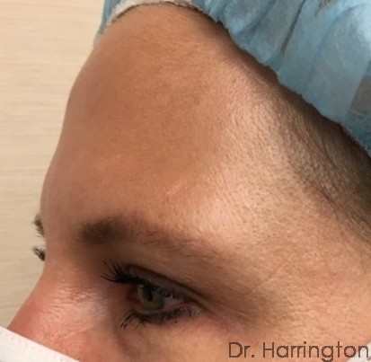 Botox Patient Photo - Case 101 - after view-2