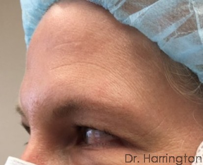 Botox Patient Photo - Case 101 - before view-2