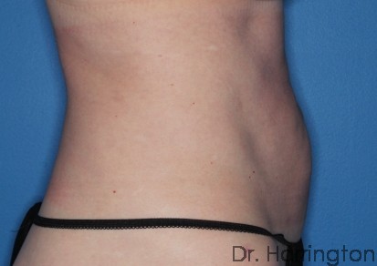 Liposuction Patient Photo - Case 104 - after view-2