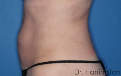 Liposuction Patient Photo - Case 104 - after view-1