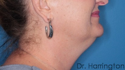 CoolSculpting® Patient Photo - Case 105 - before view-2