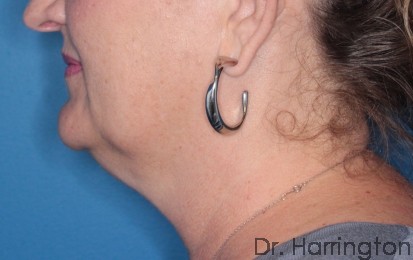 CoolSculpting® Patient Photo - Case 105 - before view-1