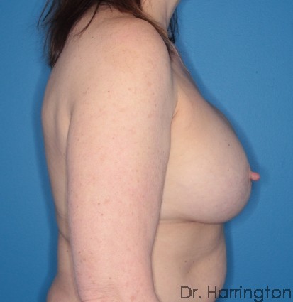 Implant Removal Patient Photo - Case 106 - before view-2