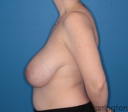 Breast Reduction Patient Photo - Case 108 - before view-1