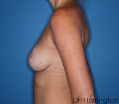 Breast Lift Patient Photo - Case 109 - after view-1