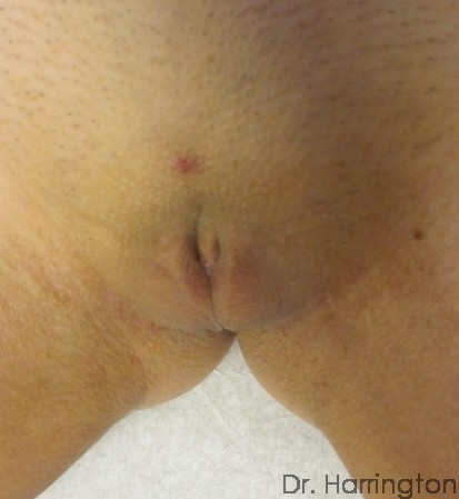 Labiaplasty Patient Photo - Case 110 - after view-1