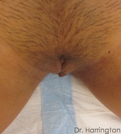Labiaplasty Patient Photo - Case 110 - before view-1