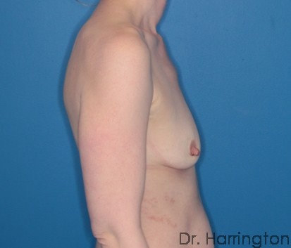 Breast Augmentation Patient Photo - Case 112 - before view-2