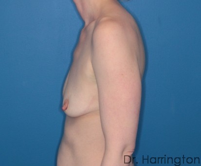 Breast Augmentation Patient Photo - Case 112 - before view-1