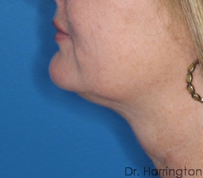 CoolSculpting® Patient Photo - Case 115 - before view-1