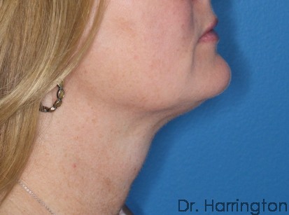 CoolSculpting® - Case 115 - After