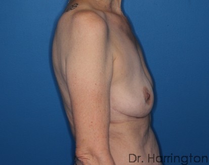 Implant Removal Patient Photo - Case 116 - after view-2