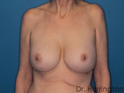 Implant Removal - Case 116 - Before