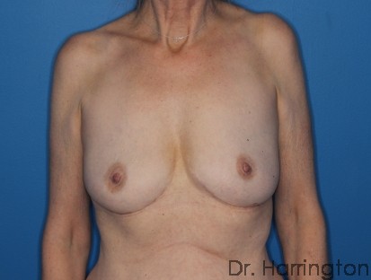 Implant Removal - Case 116 - After