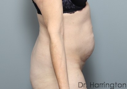 Tummy Tuck Patient Photo - Case 117 - before view-2