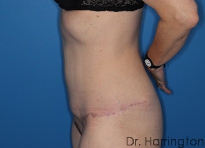 Tummy Tuck Patient Photo - Case 117 - after view-1