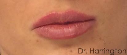 Filler - Case 122 - After