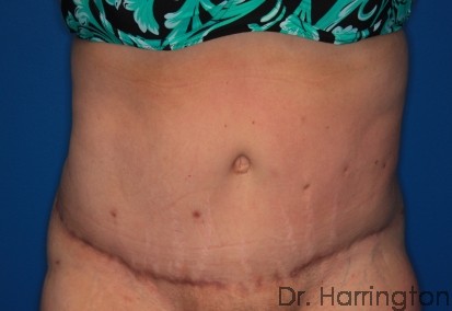 Tummy Tuck - Case 128 - After