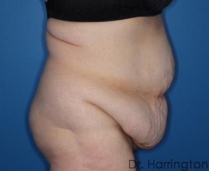 Tummy Tuck Patient Photo - Case 128 - before view-1