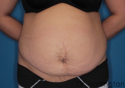 Tummy Tuck - Case 133 - Before
